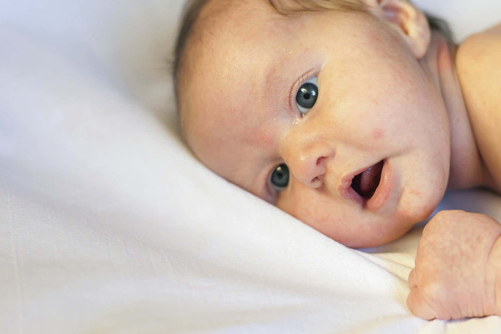 3 Cara Merawat Jerawat Bayi Supaya Tidak Bertambah Parah