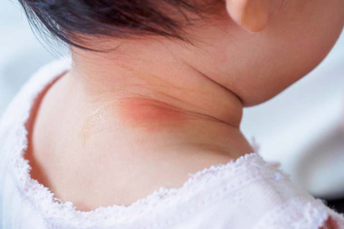 5 Penyebab Leher Bayi Kemerahan dan Apa yang Bisa Ortu Lakukan