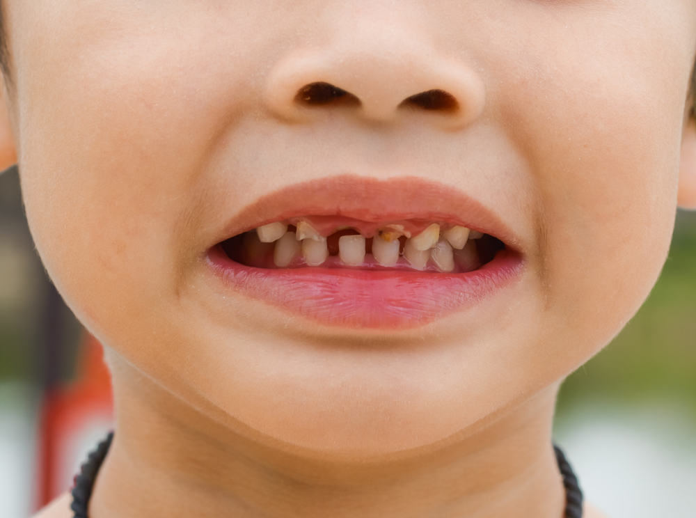 3 Kerusakan Gigi pada Anak dan Penyebabnya
