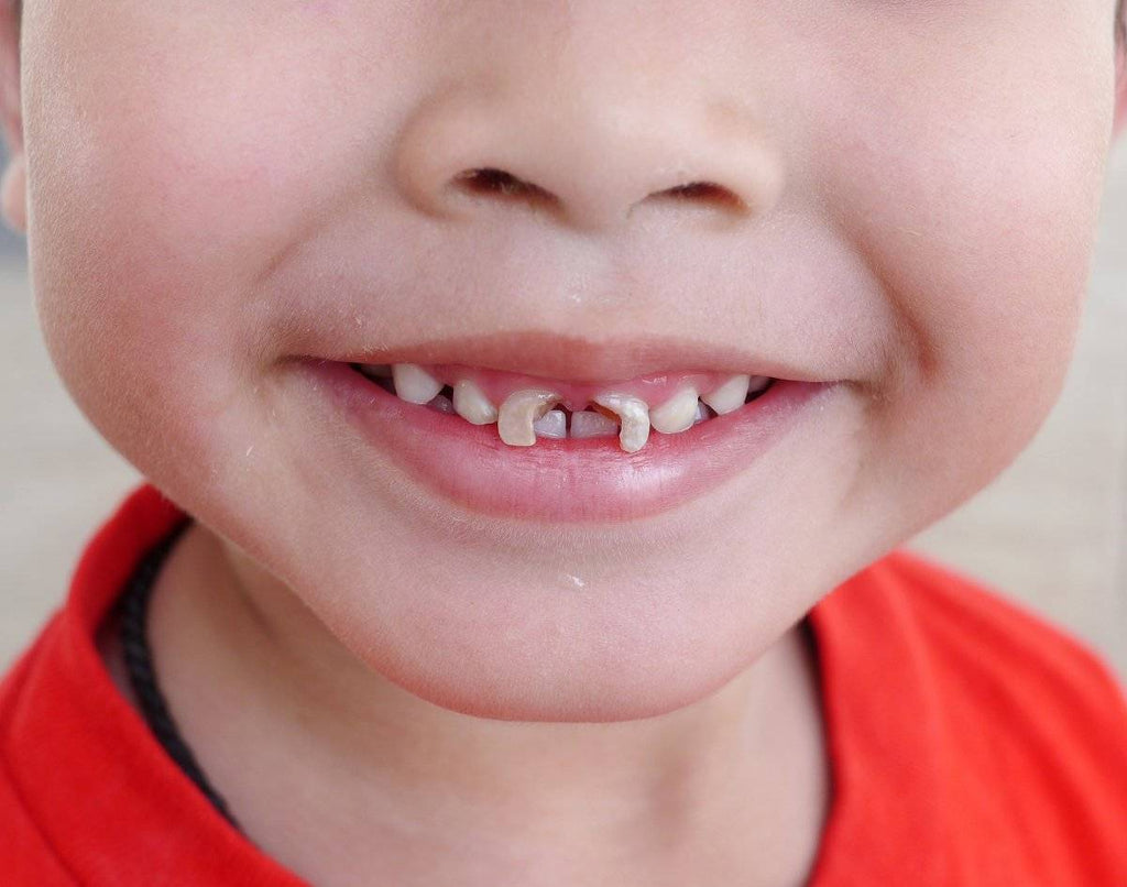 3 Cara Mencegah Gigi Berlubang Pada Anak